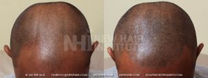 Scalp MicroPigmentation - New Hair Institute - Bold, Shaved Look - Patient 3