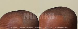 Scalp MicroPigmentation - New Hair Institute - Bold, Shaved Look - Patient 3b