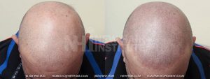 Scalp MicroPigmentation - New Hair Institute - Bold, Shaved Look - Patient 9a