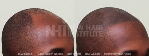 Scalp MicroPigmentation - New Hair Institute - Bold, Shaved Look - Patient 15
