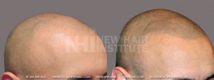 Scalp MicroPigmentation - New Hair Institute - Bold, Shaved Look - Patient 19b