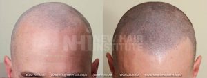 This young man had a hair transplant with poor results. He was left with a significant scar on the back of his head and visible scars in the front where the transplants failed. He still wanted to address his balding problem. When he shaved his head, the scar in both the front and the back of the head showed more dramatically, and when he let his hair grow out, the balding and the failed hair transplant bothered him.  Scalp micropigmentation solved the problem for him. The scar was camouflaged and he like his shaved look. His self confidence improved significantly.