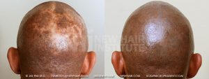 Scalp MicroPigmentation - New Hair Institute - Bold, Shaved Look - Patient 21b 