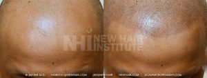 Scalp MicroPigmentation - New Hair Institute - Bold, Shaved Look - Patient 22b