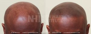 African American male with advanced balding and sun damage to his skin. The hair does protect the scalp from sun damage. He was not a good candidate for hair transplantation and selected scalp micropigmentation to address his advanced balding to address the balding problem and the cosmetics of the sun damage, but he will have to be careful to keep out of the sun as scalp micropigmentation does nothing to help him on the sun damage part and even worse, the ‘dots’ might turn blueish if he get a lot of direct sun exposure. He was very happy with the result and understood the issue of protecting his scalp from the sun.