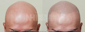 Scalp MicroPigmentation - New Hair Institute - Bold, Shaved Look - Patient 26a
