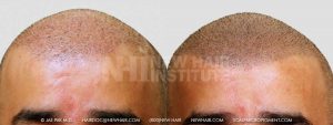 Scalp MicroPigmentation - New Hair Institute - Bold, Shaved Look - Patient 32b