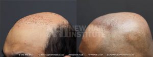 Scalp MicroPigmentation - New Hair Institute - Bold, Shaved Look - Patient 37b