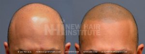 This picture reflects a typical 29 year old young man with male patterned balding and some residual hair that was so sparse, that it bothered him every day when he looked in the mirror remembering what he looked like years ago. He had scalp micropigmentation because he did not want a surgery and was willing to shave his head in the future. He loved his results and shaving his hair turned out to be no sacrifice for him.