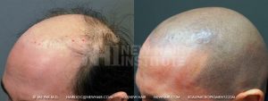 Scalp MicroPigmentation - New Hair Institute - Bold, Shaved Look - Patient 71b