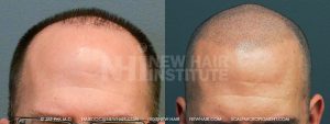 This 44 year old male had hair transplants in the front which never really filled in the bald area enough to cover his frontal balding. He was very disappointed with his hair transplant surgeon who promised him a full head of hair. He had a typical Class 4A balding pattern and the pugs showed up too much for his comfort, so his doctor recommend still another transplant. Instead, he heard about scalp micropigmentation and had SMP with us. You can see which met his and out expectations. He can, at his choosing, darken the frontal area if he wished; however, he was happy with this style and this look.
