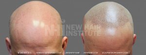 A typical young man with a Class 6 balding pattern. Note that there is significant sun damage to the balding scalp area. The SMP does not treat the sun damaged areas, but it hides it nicely as shown in these pictures. He will have to stay out of the sun and/or use strong skin blockers or a hat when going into the sun. Otherwise, the SMP gave him the freedom he was looking for.