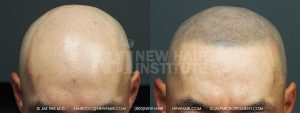 Previous hair transplant patient (note the fine rows of hair transplant grafts in the before picture). You can imagine how he felt when he shaved his head and the problem looked worse than with his hair longer. The coverage with more transplants did not work to his liking. The SMP covered the visible grafts and gave him the freedom from worrying about more hair transplants which he would have been required for his Class 6 balding pattern if he went the hair transplant route. .