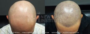 Scalp MicroPigmentation - New Hair Institute - Bold, Shaved Look - Patient 89b