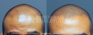 Scalp MicroPigmentation - New Hair Institute - Bold, Shaved Look - Patient 97