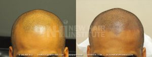 A 32 year old male with frontal hair loss and a persistent forelock. Many balding men have a forelock that persists into older age despite the balding around it. Also, these tend to be in family lines, and as expected, his balding father and his balding grandfather kept their forelocks into the senior years. Scalp micropigmentation works even better when there is a forelock as the patient who shaves his head can let the hair grow out just enough to feel the hair ends. This was the case in this patients.
