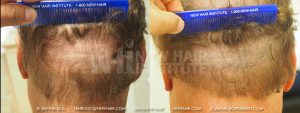 Scalp MicroPigmentation - New Hair Institute - Bold, Shaved Look - Patient 143