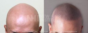 One of my favorite patients. He has a disease called alopecia totalis. He has no body hair and no head hair. His eyebrows are artificial. He was wearing a hat for the past 10+ years, never taking it of when outside or with people. He had the scalp micropigmentation and walked our of the office with no hat on. We all had that warm and fuzzy feeling watching his joy. He often visits us and comes to our open house events monthly.  A few years ago, he went to a International Society For Hair Restoration Surgeons meeting with me and came up on the stage as I presented him before over 400 doctors at the meeting. After the presentation, there was a reception line especially for him, and the doctors lined up to see him and touch his ‘hair’ that was not hair just a tattoo. This patient rarely ever met any doctors, so this was an intimidating experience for him. Once he started to see the doctors and speak with them, he related that they told that they did not believe that he had no hair, and that made him feel real good.