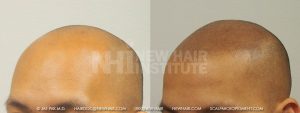 Scalp MicroPigmentation - New Hair Institute - Bold, Shaved Look - Patient 148