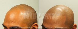 Scalp MicroPigmentation - New Hair Institute - Bold, Shaved Look - Patient 168