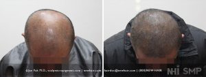 A 39 year old Asian male with significantly advanced balding. He elected to shave his head and have scalp micropigmentation done. If he does not bald further, this is a look he can accept for life. If more hair is lost, he can get touchups for the SMP.
