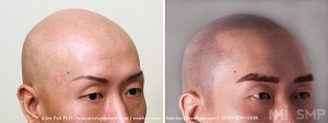 Scalp MicroPigmentation - New Hair Institute - Bold, Shaved Look - Patient 147b