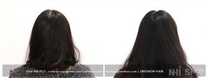 A women with thinning hair wanted who Scalp micropigmentation to cover not only the central part of the scalp, but also most of the scalp which shows the thinning as she changes her hair style. Now she can style her hair anyway she wanted. 