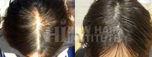 Female with thinning treated with scalp micropigmentation. This is one of our typical thinning female patients. Unfortunately, we did not clean her hair up at the time this after picture was taken, but if you look at the scalp between the before and after, the results are obvious.