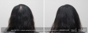 Female with thinning hair successfully treated with Scalp Micropigmentation