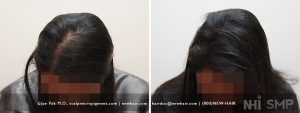 26 year old female with thinning over the entire frontal and top area of the head. She combs her hair to the side to hide some of the balding and that styling technique partly works. With Scalp Micropigmentation, any styling will work. 